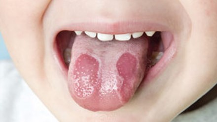 Nhận biết điều trị bệnh nấm miệng ở trẻ nhỏ